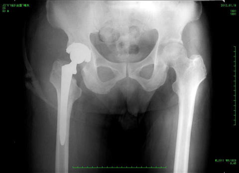 壊死 大腿 骨 股関節の疾患「大腿骨頭壊死について（２） ～検査と診断～」